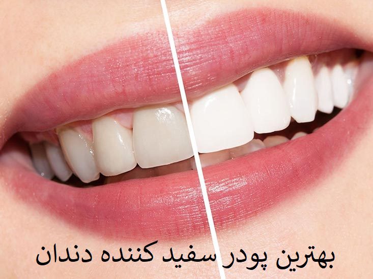 بهترین پودر سفید کننده دندان